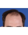 Before Hair Transplant &nbsp;Front